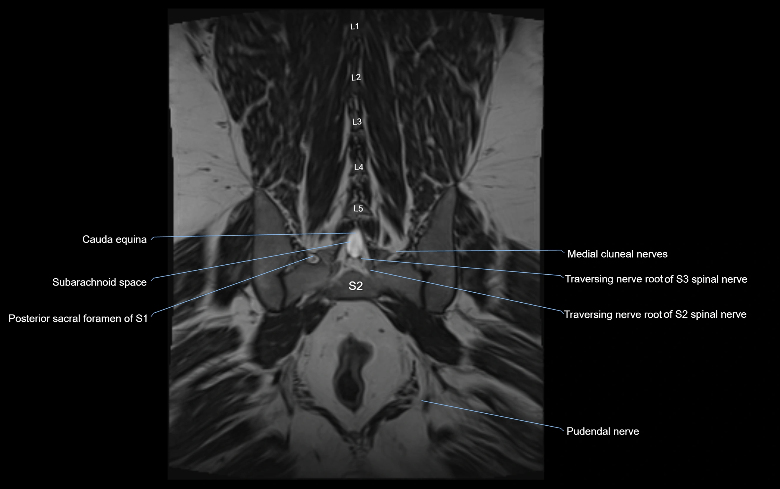 MR lumbosacral plexus cross sectional anatomy 3T  radiology  image-img-09001-00060.webp